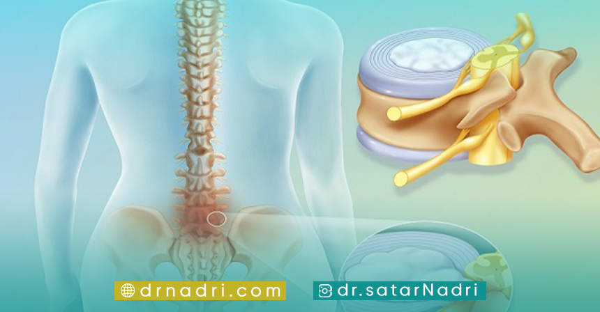 انواع جراحی دیسک کمر