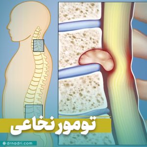 علائم و درمان تومور نخاعی