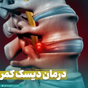 سریعترین راه درمان دیسک کمر