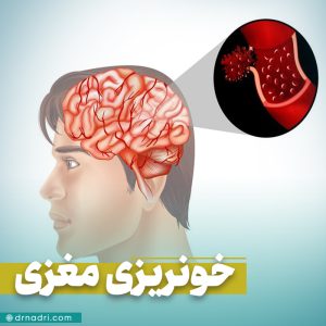 خونریزی مغزی را چطور تشخیص دهیم؟