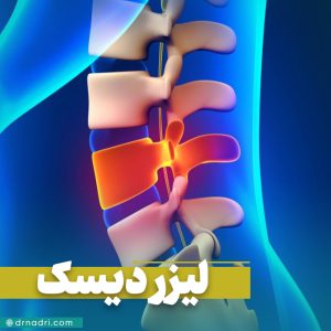 عمل دیسک کمر با لیزر