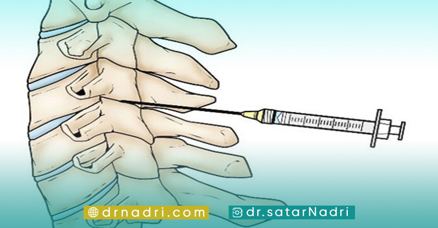 عوارض تزریق به مفصل ستون فقرات