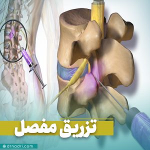 تزریق داخل مفصل ستون فقرات